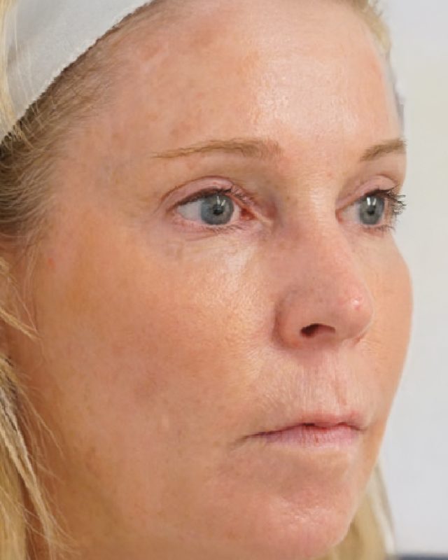 After photo of patient's skin following HALO TRIBRID treatment