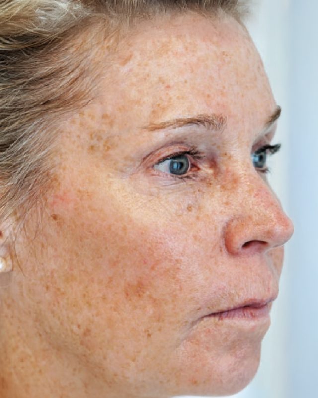Before photo of patient's skin