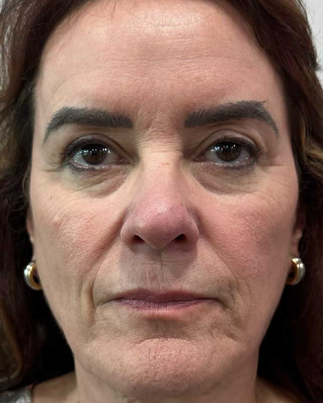 After photo of patient's skin following HALO TRIBRID treatment
