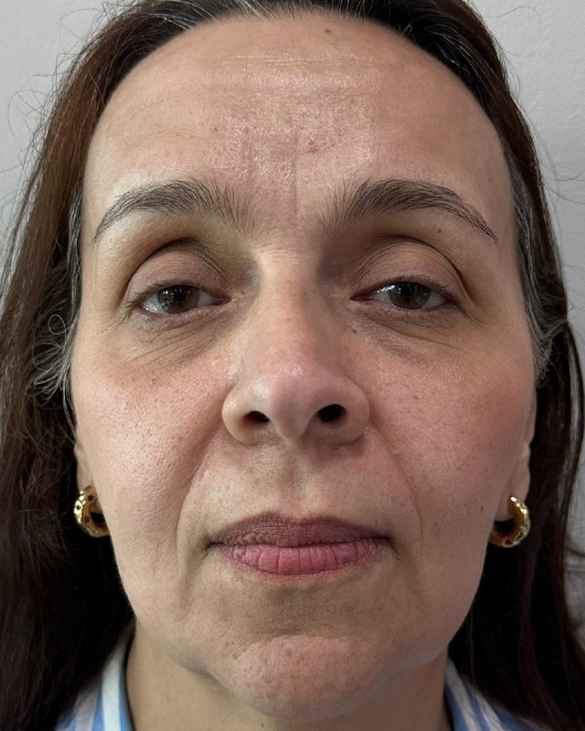 After photo of patient's skin following HALO TRIBRID treatment